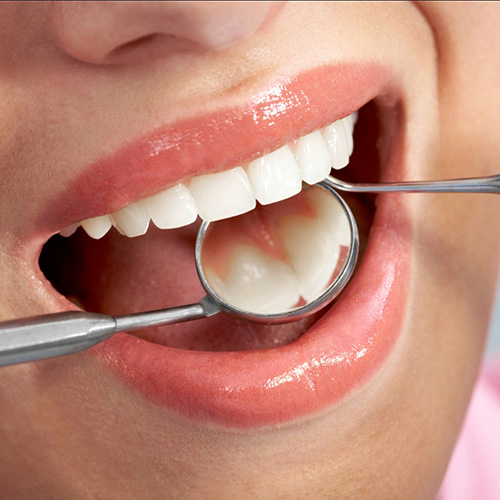 Răng Sứ Ceramco | Phục Hình Răng Sứ Ceramco